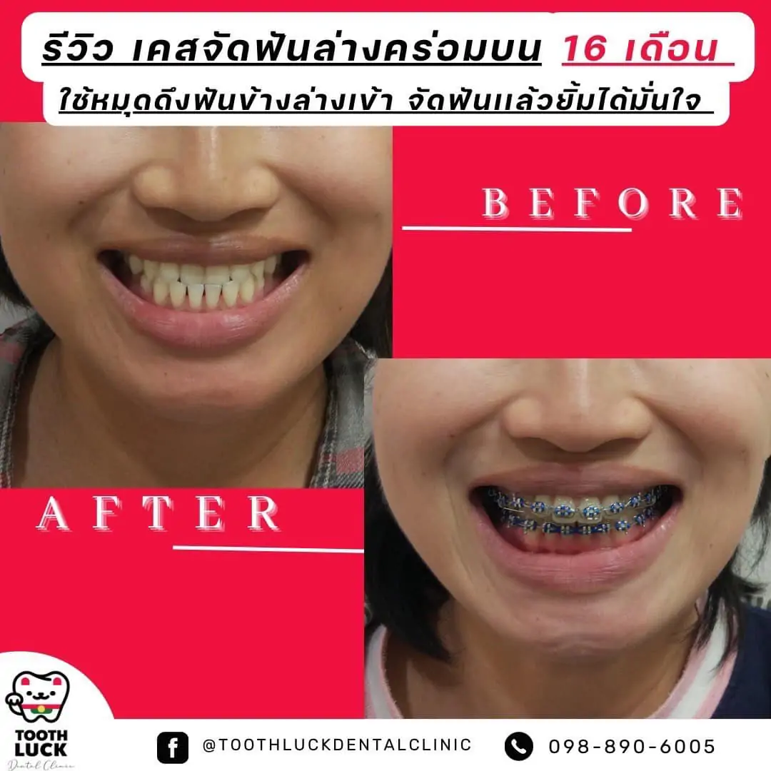 Tooth Luck dental clinic - ทำฟัน จัดฟัน ขอนแก่น