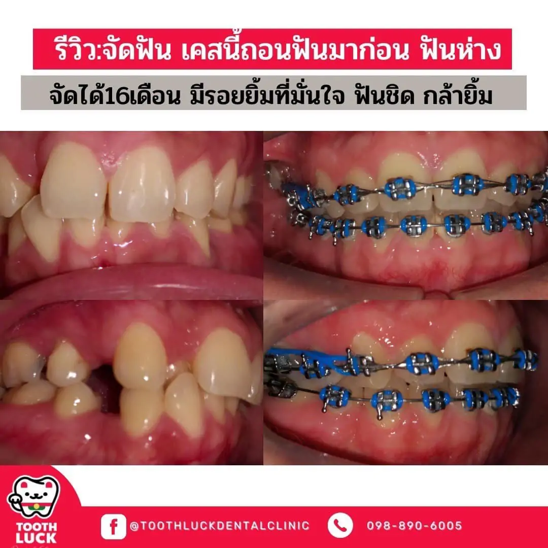 Tooth Luck dental clinic - ทำฟัน จัดฟัน ขอนแก่น