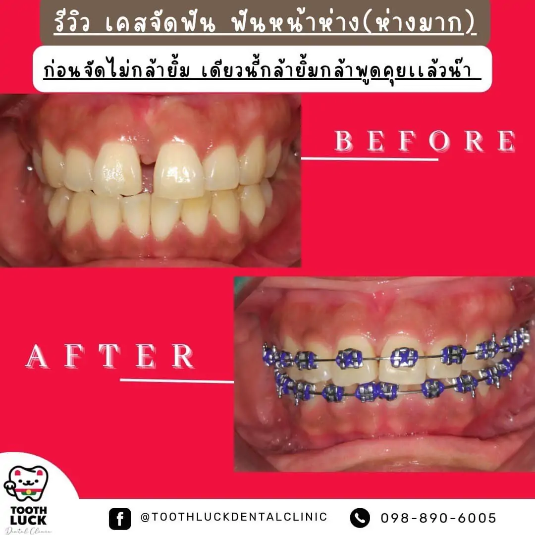 จัดฟัน Tooth Luck dental clinic - ทำฟัน จัดฟัน ขอนแก่น