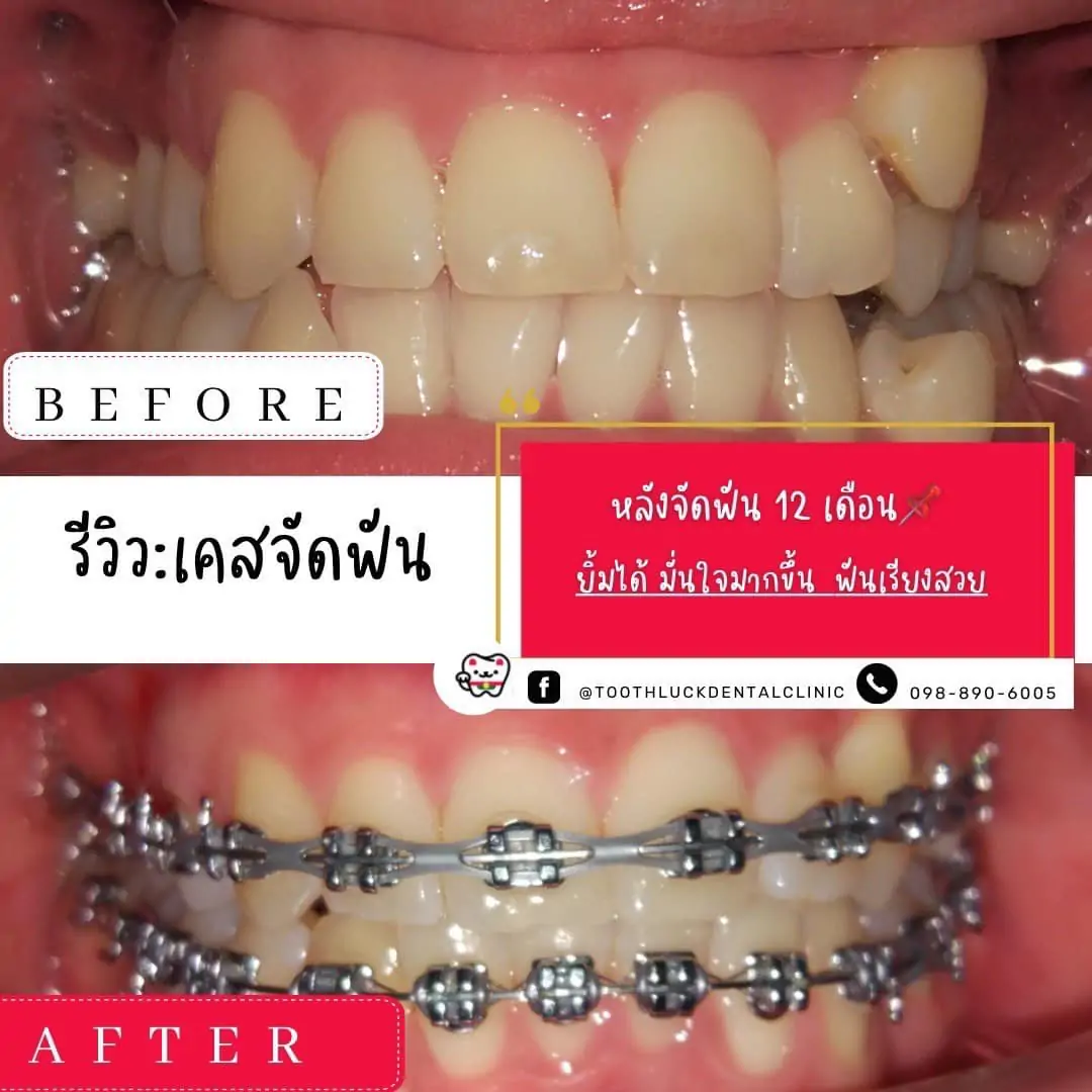 Tooth Luck dental clinic - ทำฟัน จัดฟัน ขอนแก่น