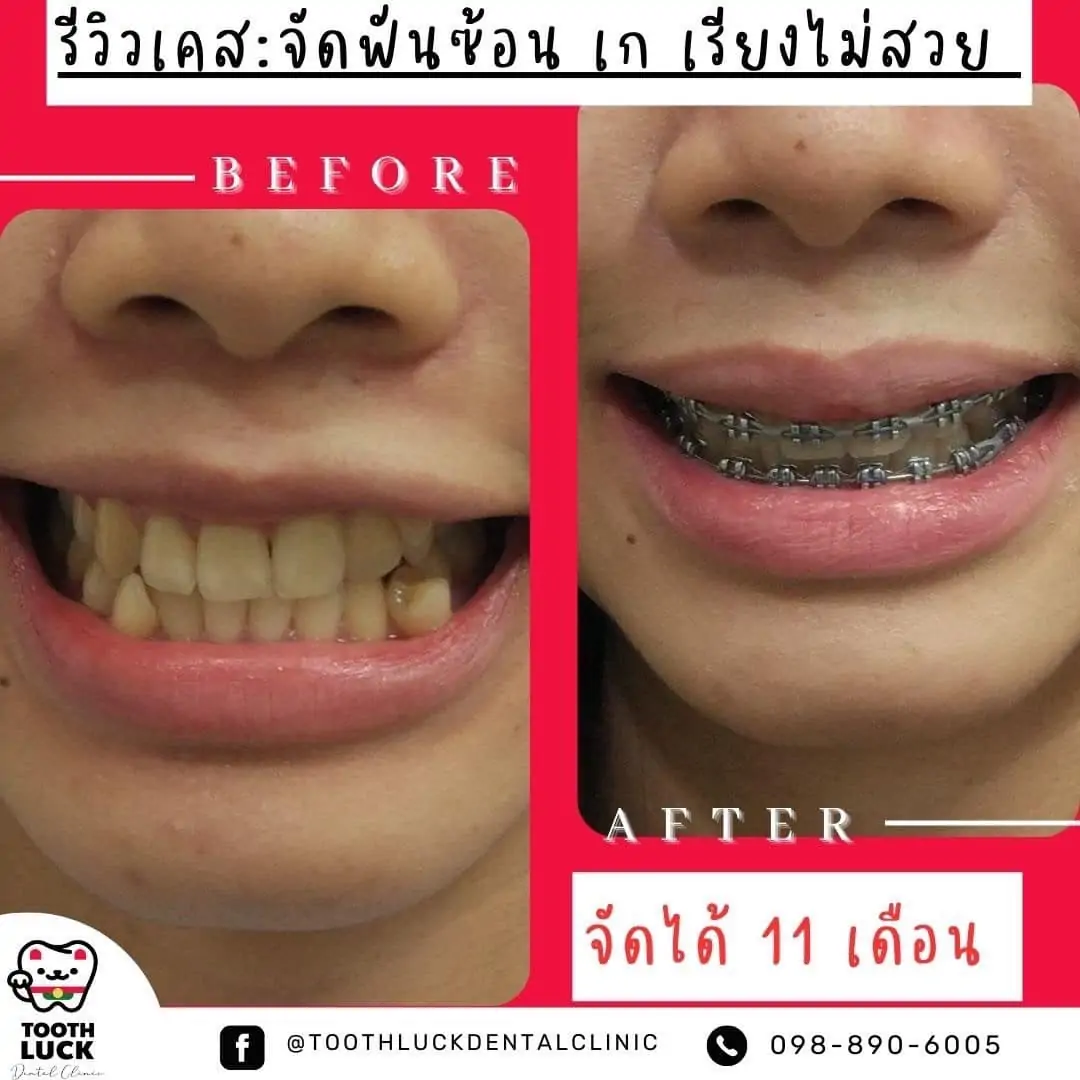 Tooth Luck dental clinic - ทำฟัน จัดฟัน ขอนแก่น