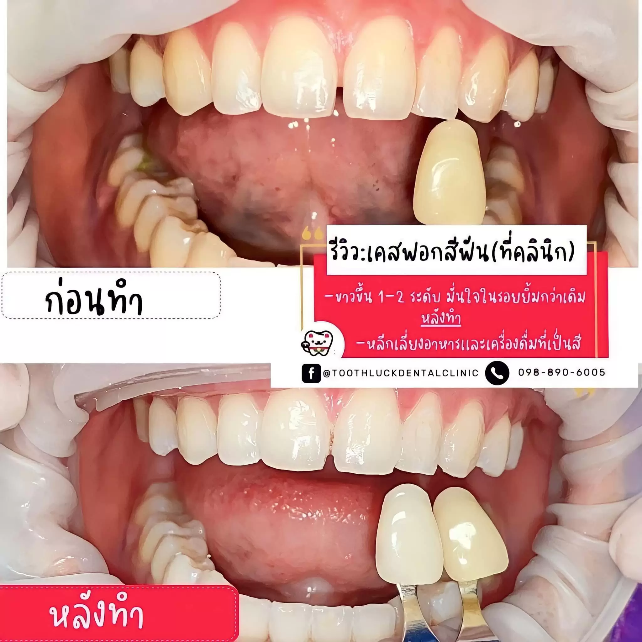 ฟอกสีฟัน