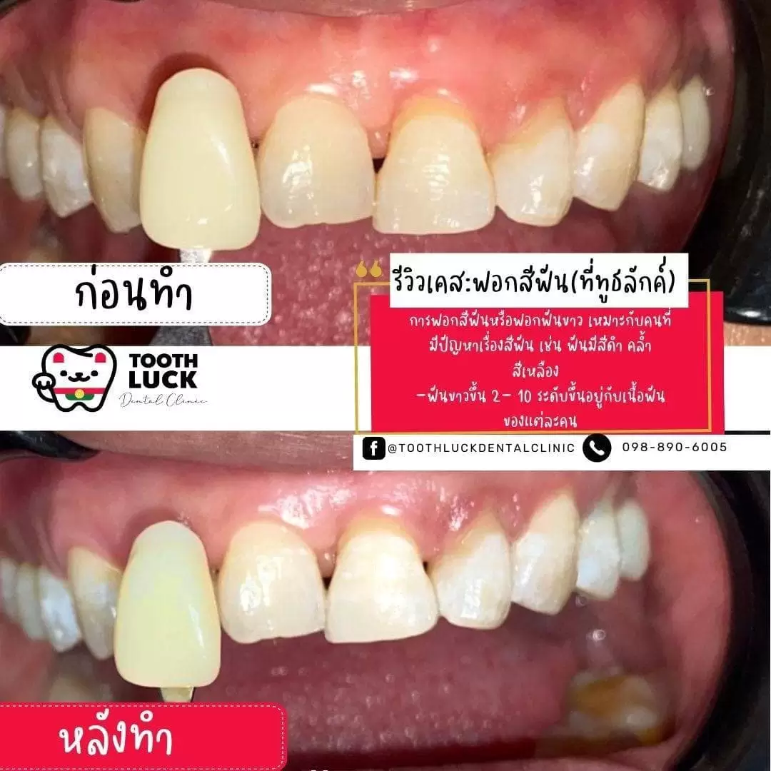 ฟอกสีฟัน