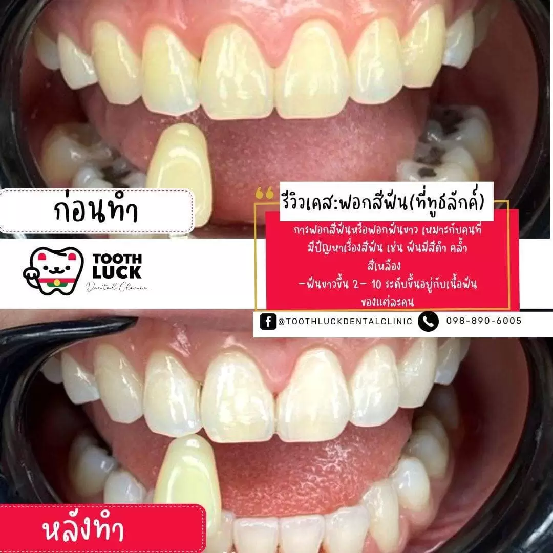 ฟอกสีฟัน
