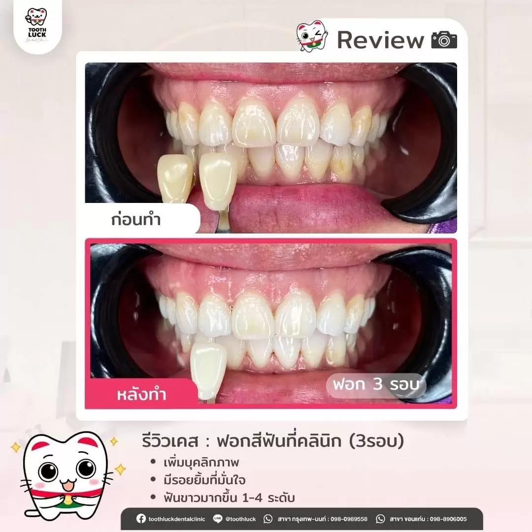 ฟอกสีฟัน