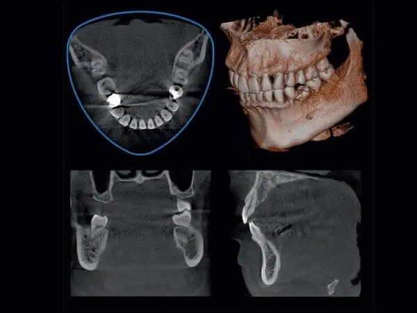 Cone Beam CT Scan