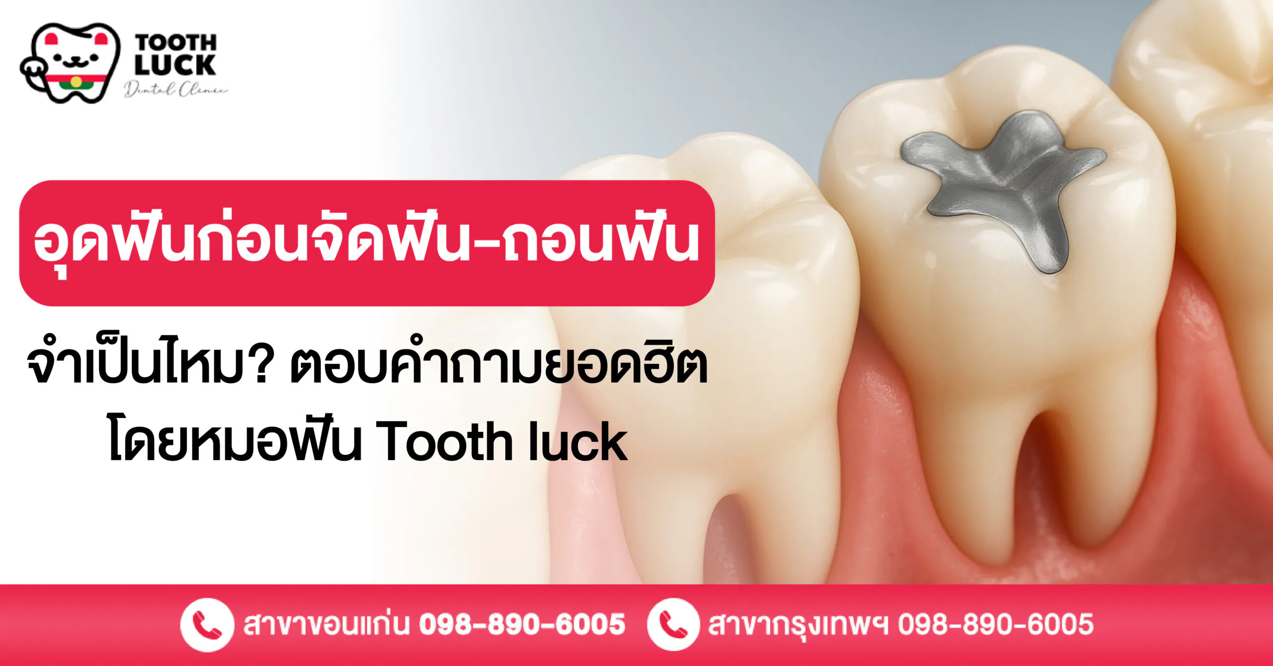 อุดฟันก่อนจัดฟัน-ถอนฟัน จำเป็นไหม? ไขข้อสงสัยกับ Tooth luck