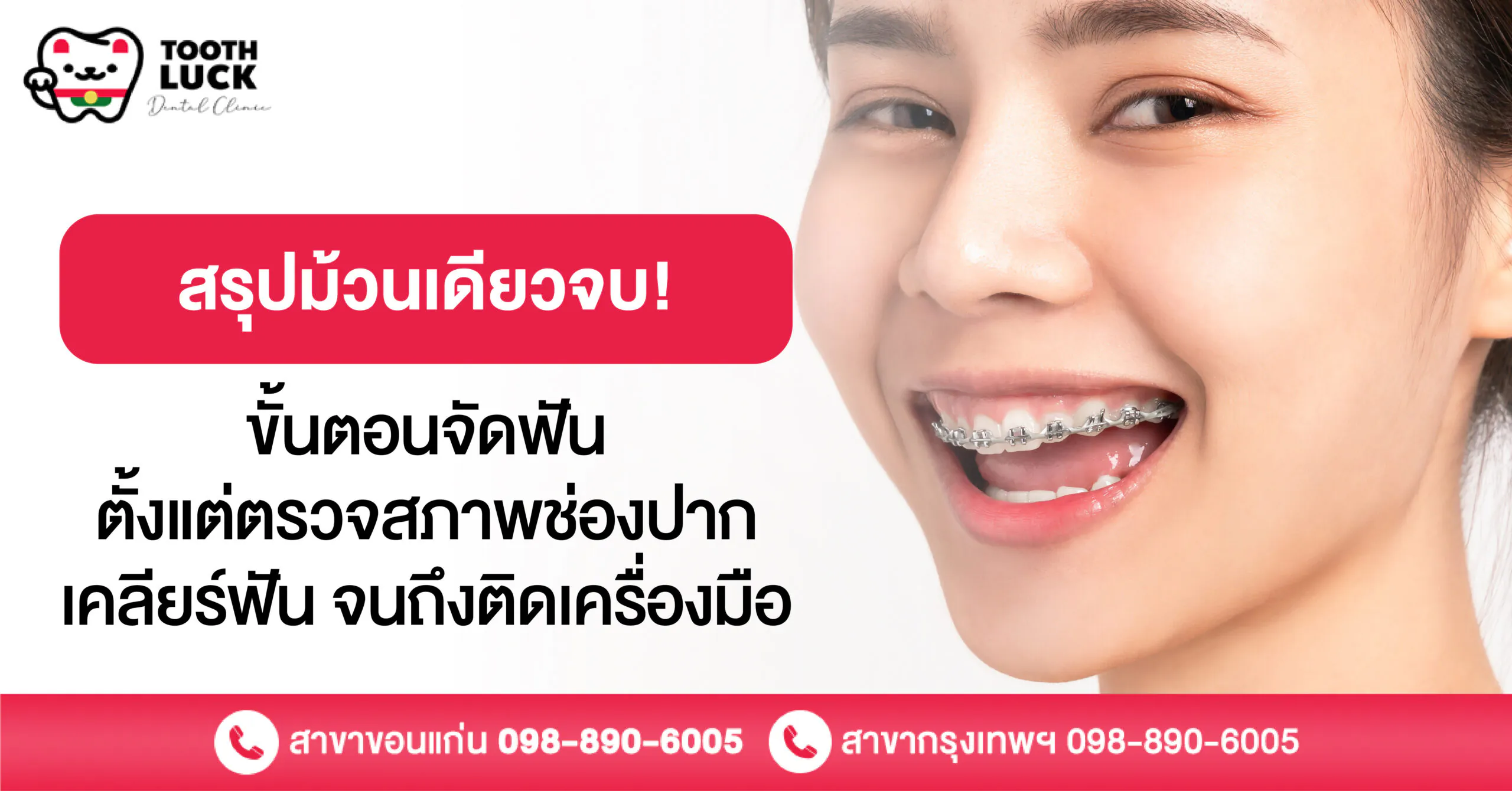 สรุป! ขั้นตอนจัดฟัน ตั้งแต่ตรวจช่องปาก เคลียร์ฟัน จนถึงติดเครื่องมือ